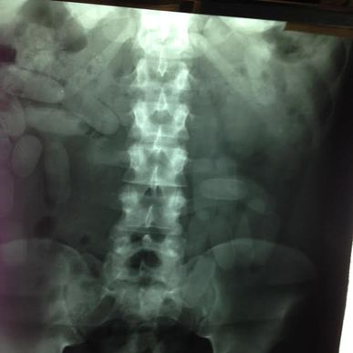 Italian Attempted to Leave Costa Rica With 101 Ovules of Cocaine In His Stomach