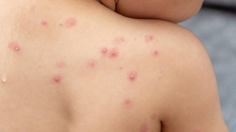 Costa Rica has not registered cases of smallpox for almost nine decades
